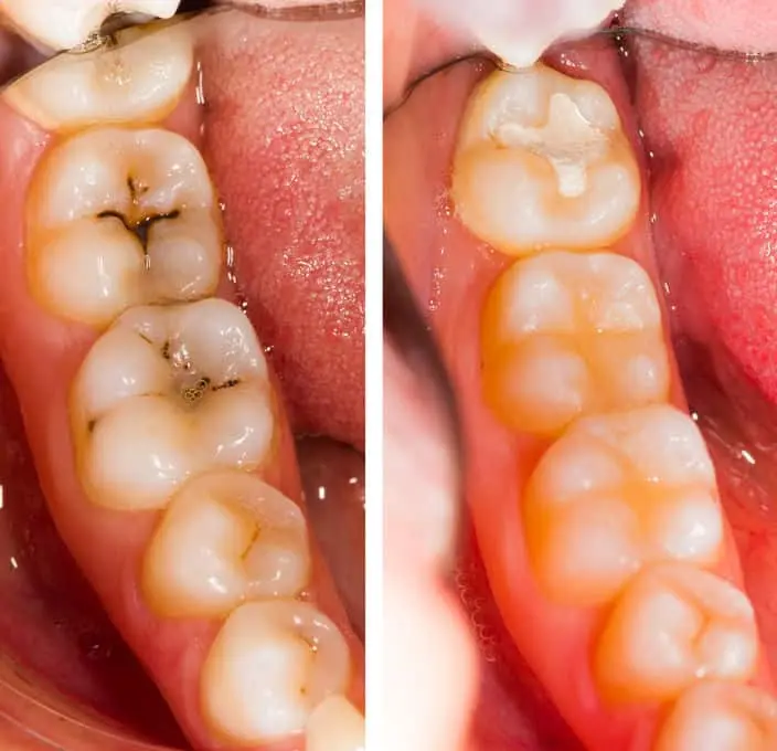 A composite filling being shaped